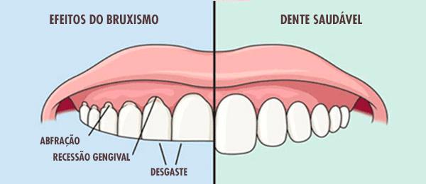 Bruxismo e Fisioterapia: Voc� sabia que o bruxismo pode causar dor de cabe�a, pesco�o e na face?