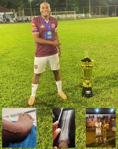 Amigos lanam ao solidria por atleta guaxupeano vtima de fratura na perna