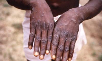 Sade confirma primeiro caso de nova cepa de mpox no Brasil